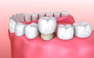 mount waverley dental crowns