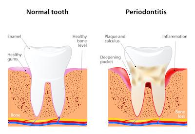 healthy gums on left and gums with periodonitis on right