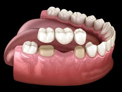 Illustration of dental bridge 