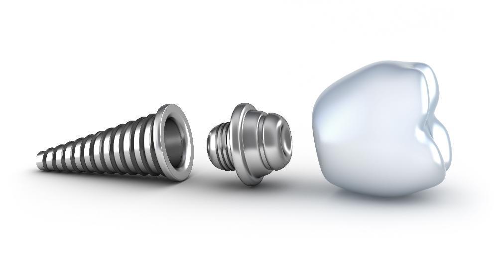 illustration of dental implant 