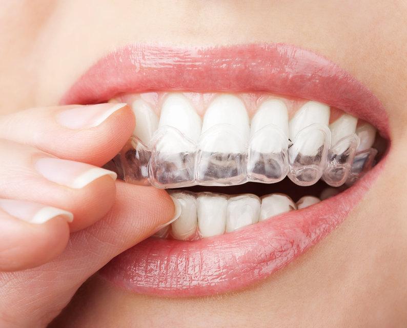 Close up of woman using Invisalign | Dentist Mount waverley VIC