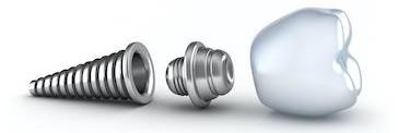 illustration of dental implant and crown