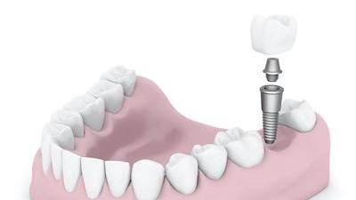 Illustration of dental implant 