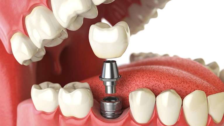 dental implant mount waverley