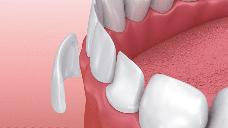 veneers in mount waverley 