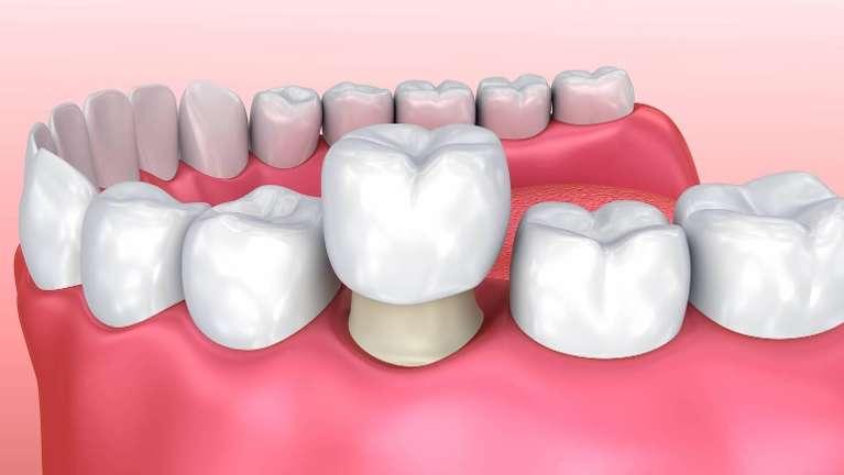 image of a dental crown in mount waverly