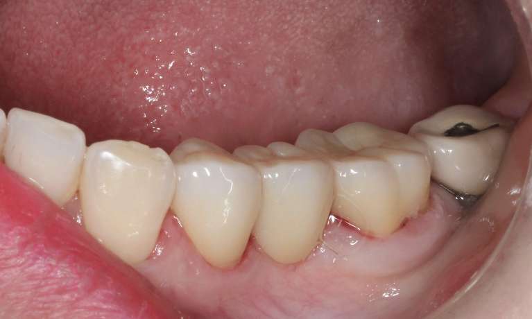 new dental bridge image in mount waverley