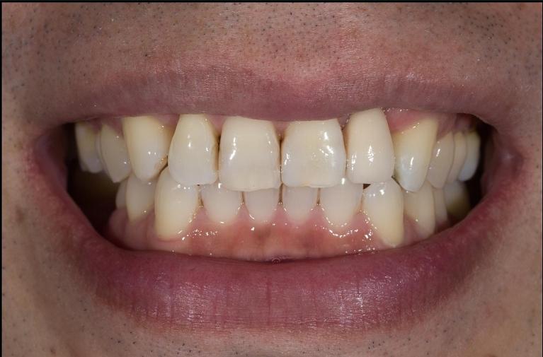 man with missing tooth replaced in mount waverley