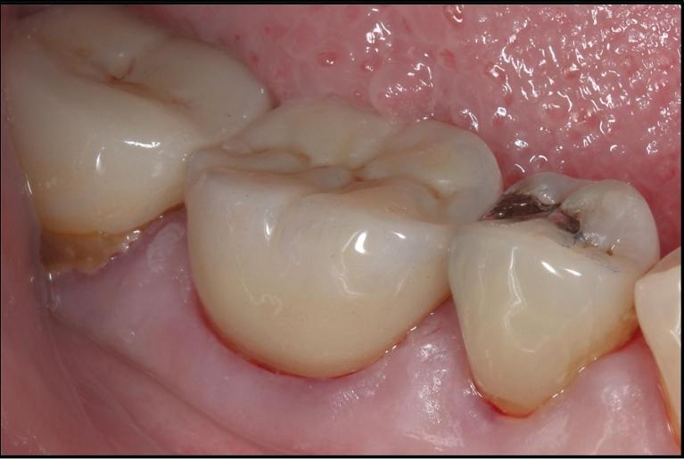 silver filling replaced with tooth coloured filling