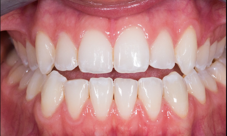 bright white smile after teeth bleaching