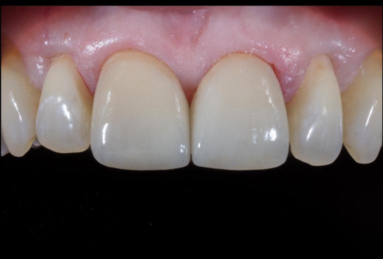 front tooth cracks fixed in mount waverley