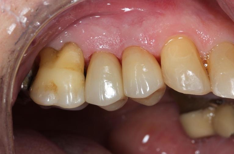 Patient with new dental crowns in mount waverley