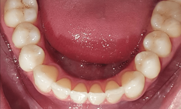 patient after invisalign treatment to straighten bottom teeth