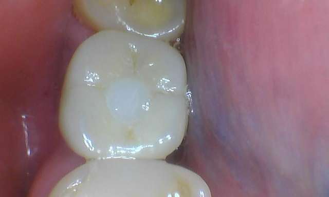 new dental crown on implant in mount waverley