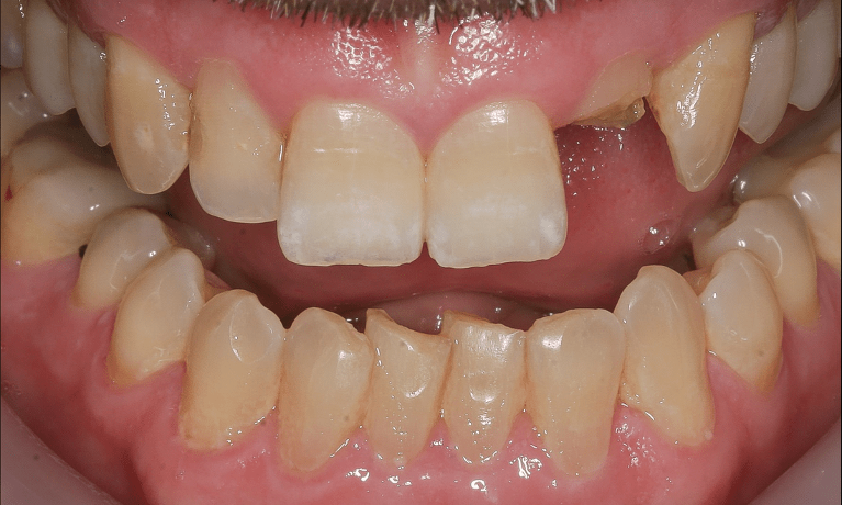Missing tooth in need of restoration