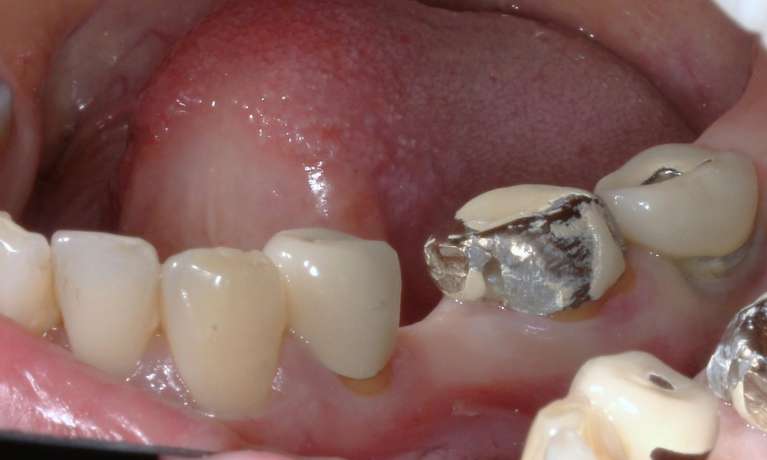 chipped tooth and crown before image