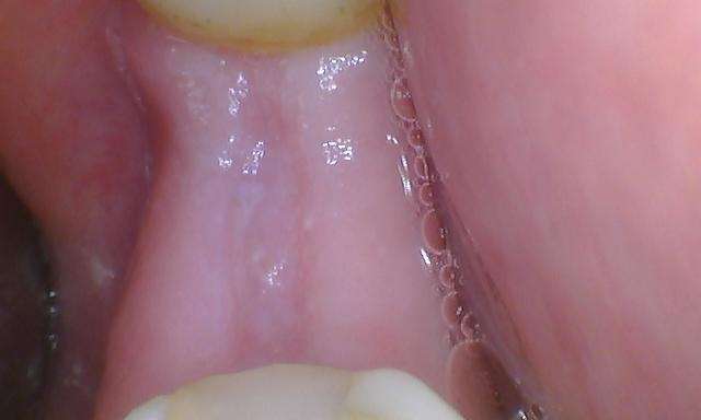 missing molar | mount waverley implants