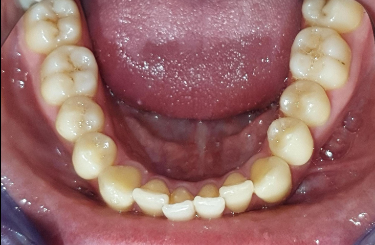 close up of crooked bottom front teeth