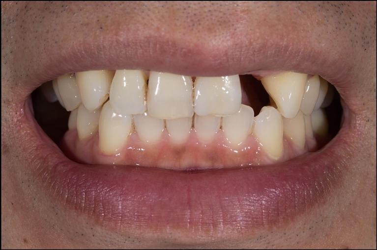 man with missing tooth in mount waverley