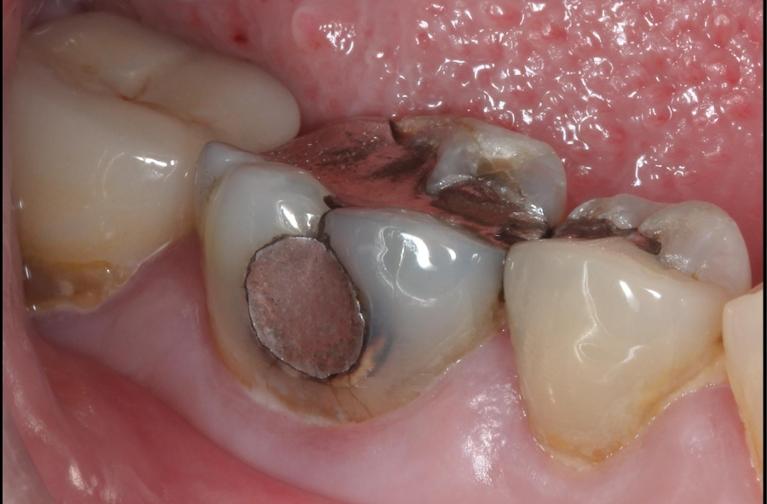 patient who needs silver filling replaced