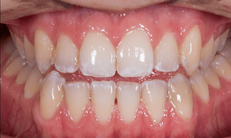 Teeth before teeth bleaching