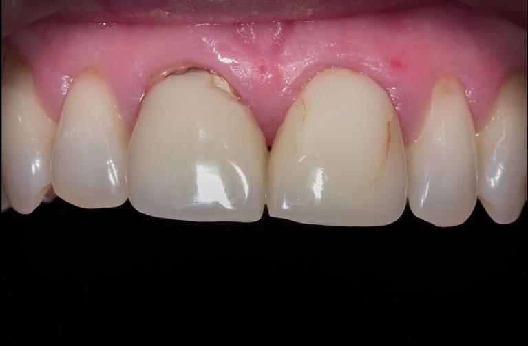 Patient with cracked front teeth in mount waverley