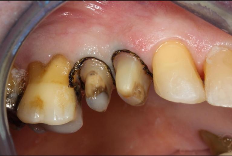 patient in need of dental crowns | Mount Waverley Dentist