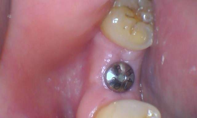 new dental implant in mount waverley photo